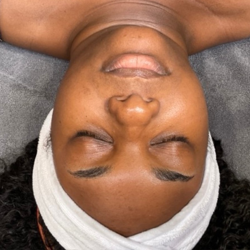 HydraFacials Before & After Image