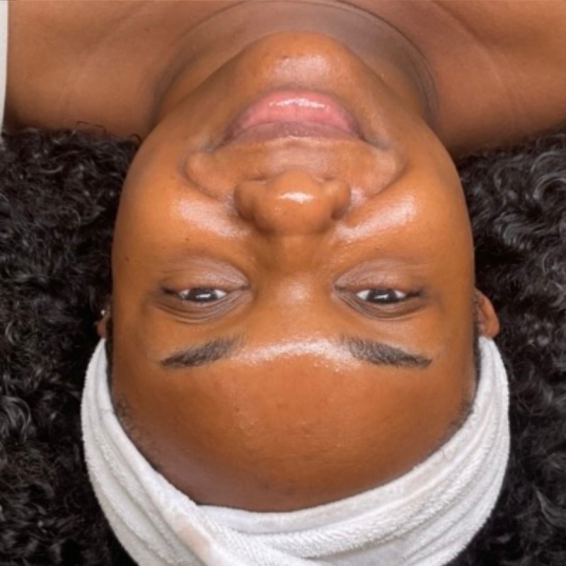 HydraFacials Before & After Image