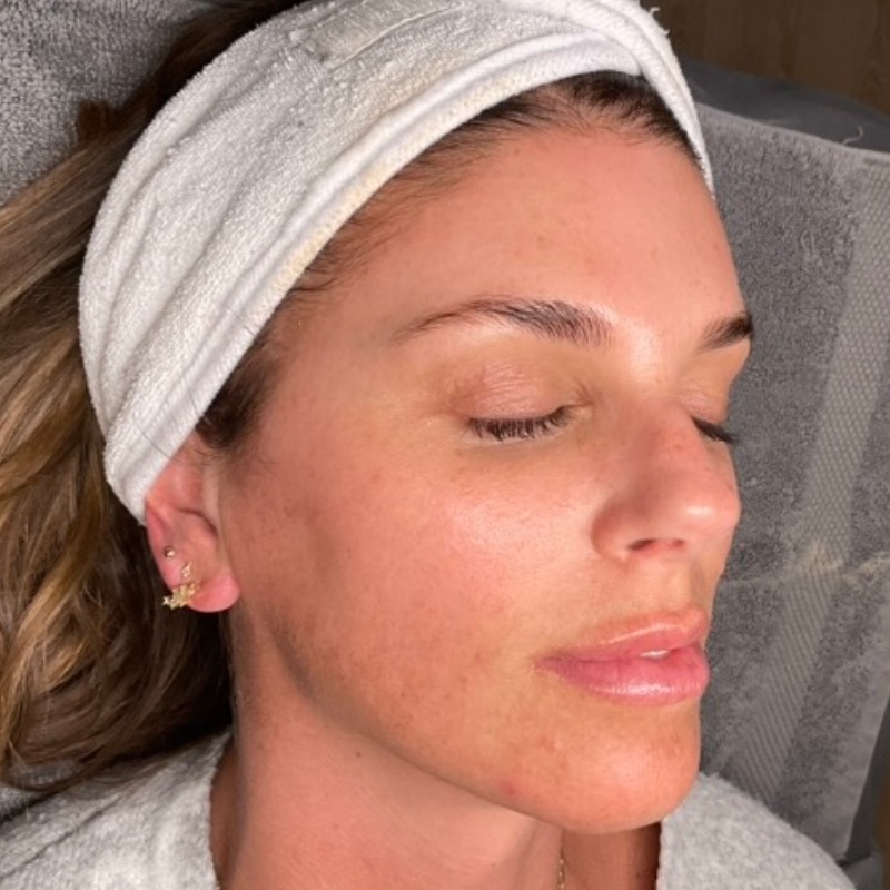 Laser Skin Resurfacing Before & After Image