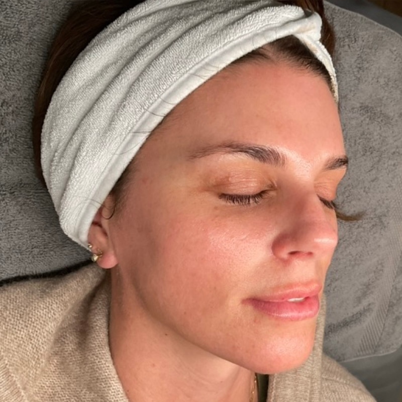 Laser Skin Resurfacing Before & After Image