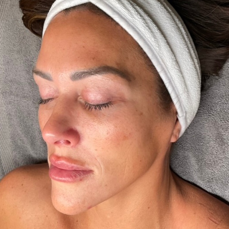 Laser Skin Resurfacing Before & After Image