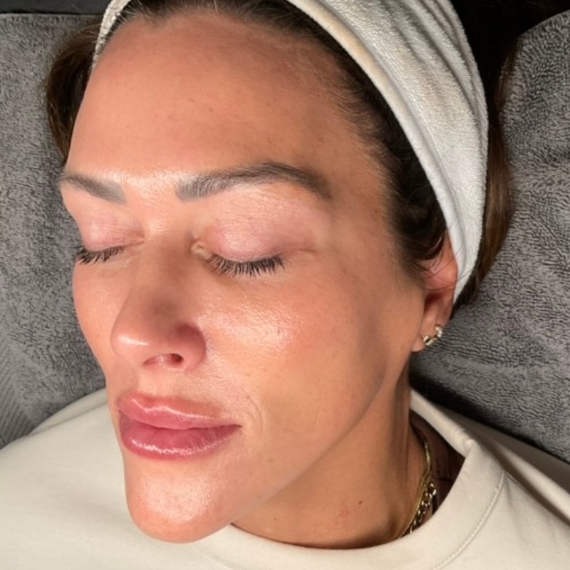 Laser Skin Resurfacing Before & After Image