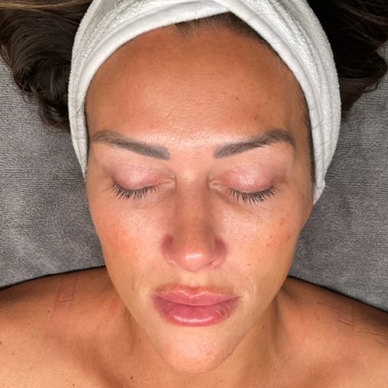 Laser Skin Resurfacing Before & After Image