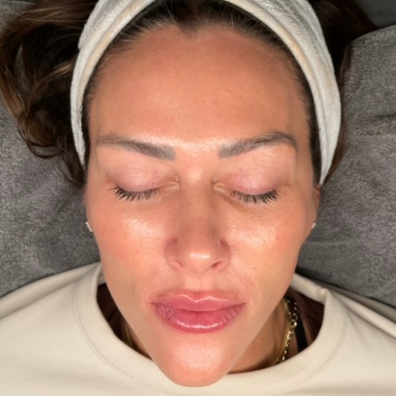 Laser Skin Resurfacing Before & After Image