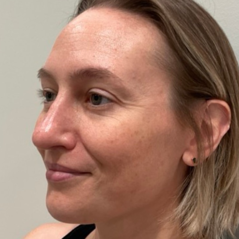 Laser Skin Resurfacing Before & After Image