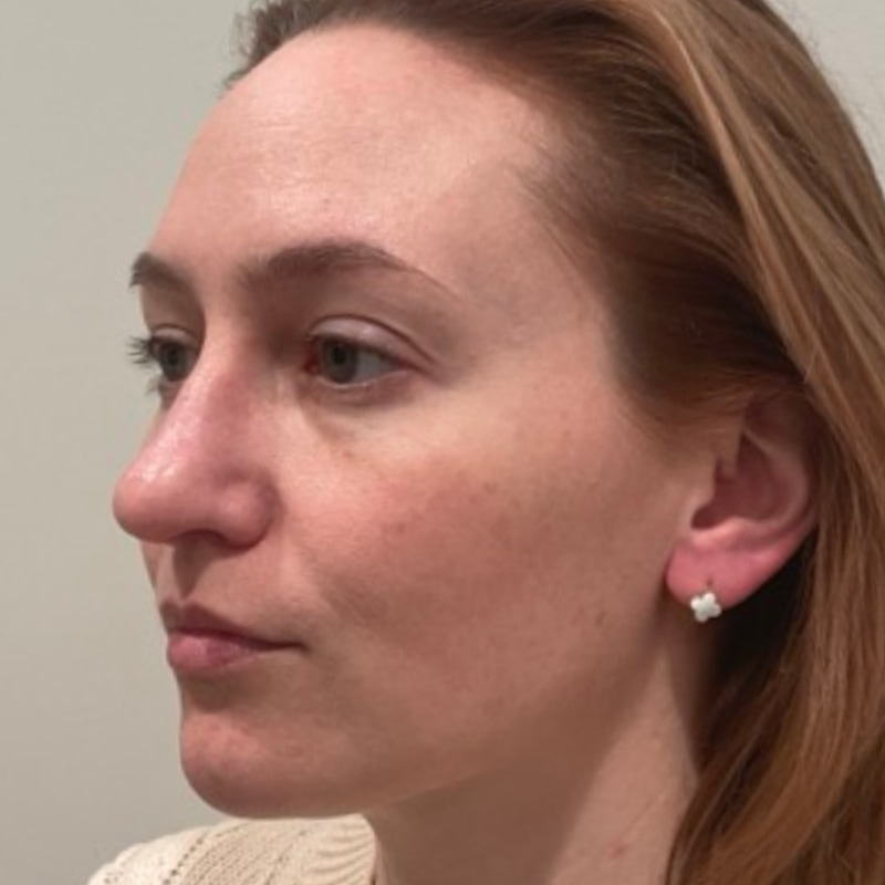 Laser Skin Resurfacing Before & After Image