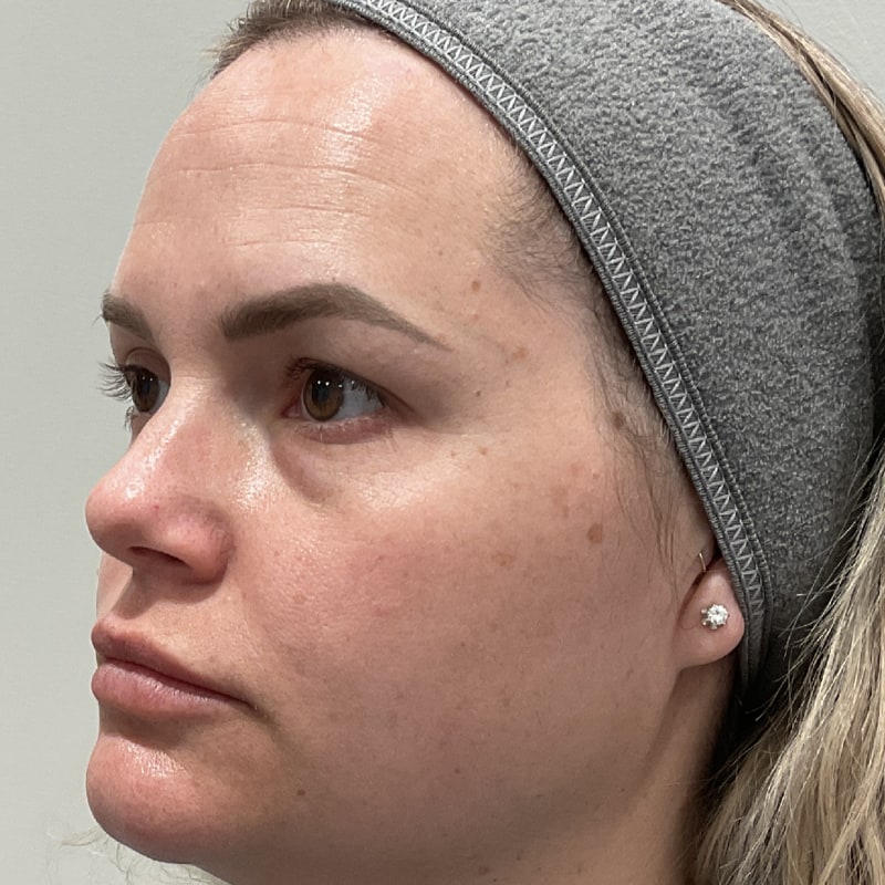 Microneedling Before & After Image