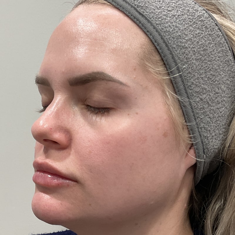 Microneedling Before & After Image