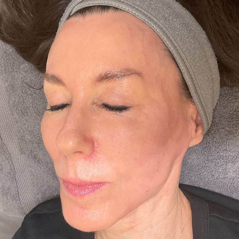 Microneedling Before & After Image