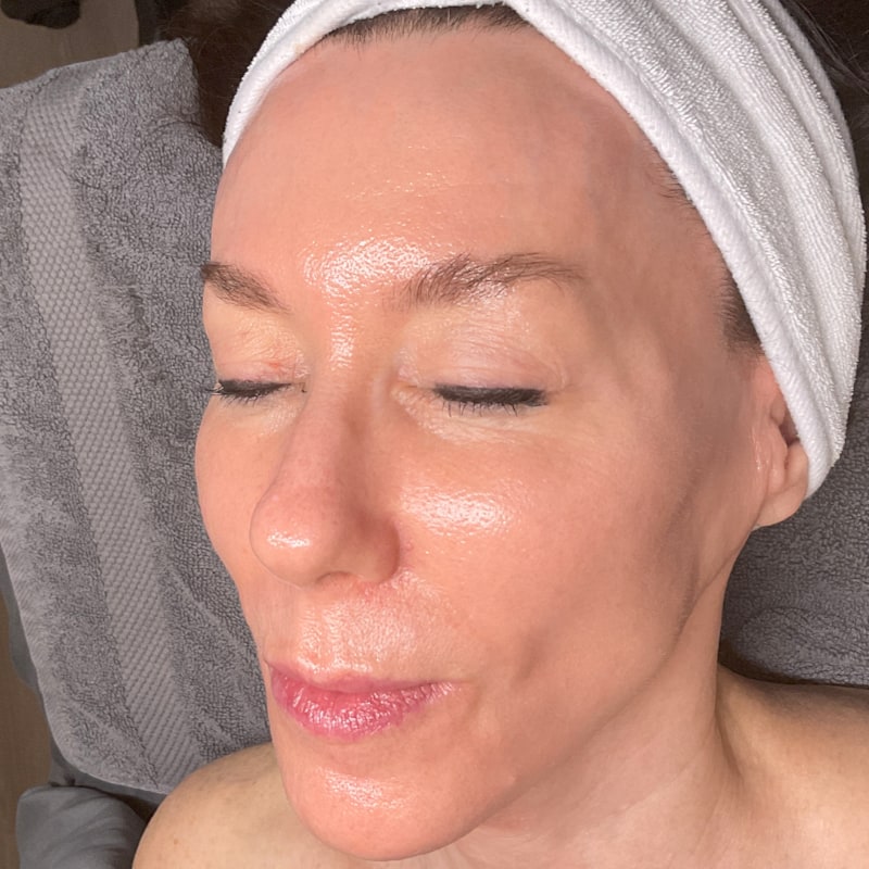 Microneedling Before & After Image