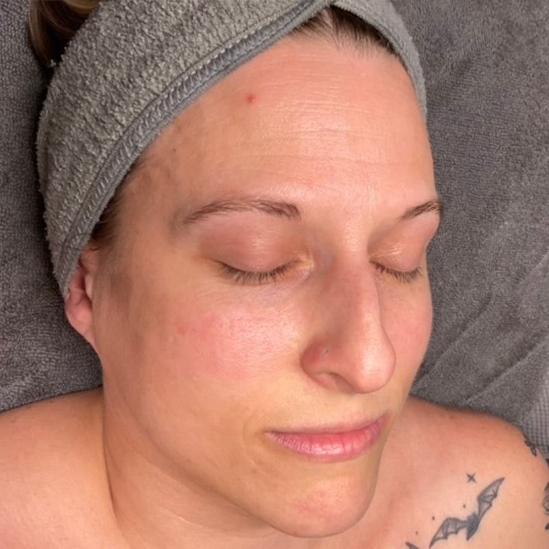 Microneedling Before & After Image