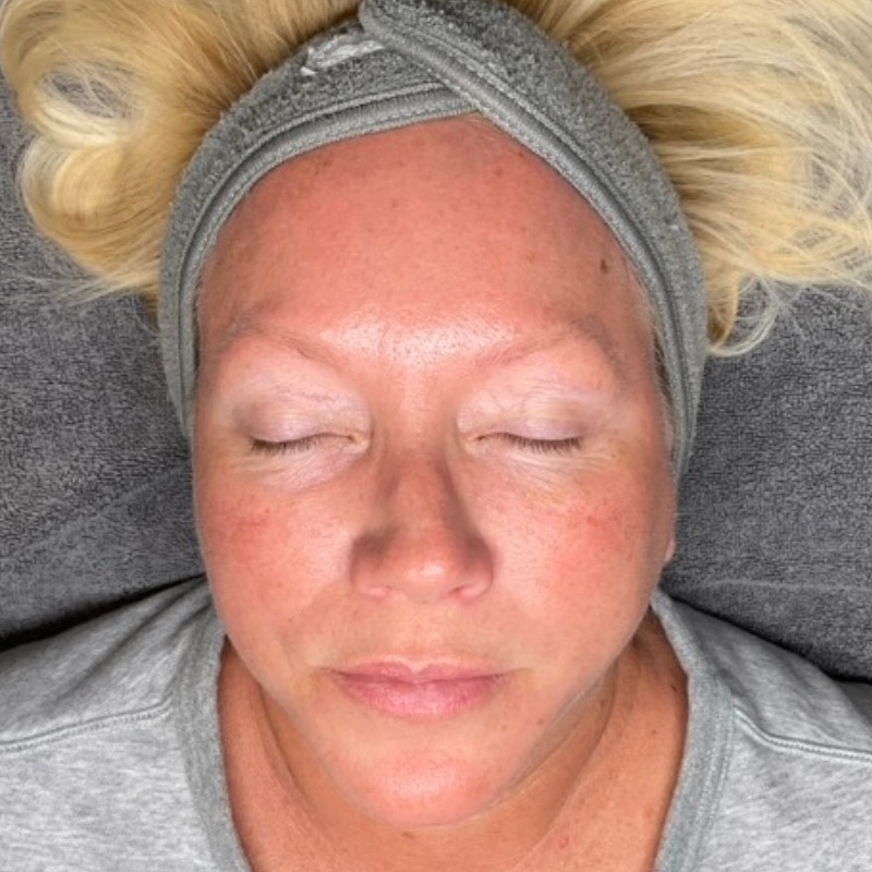 Microneedling Before & After Image