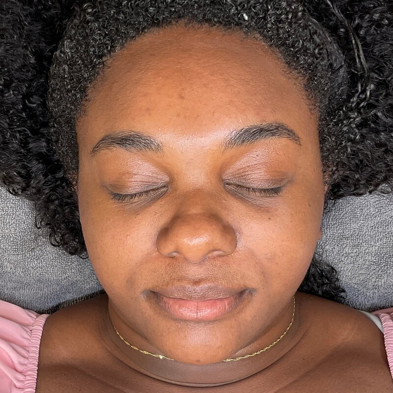 MOXI Laser Before & After Image