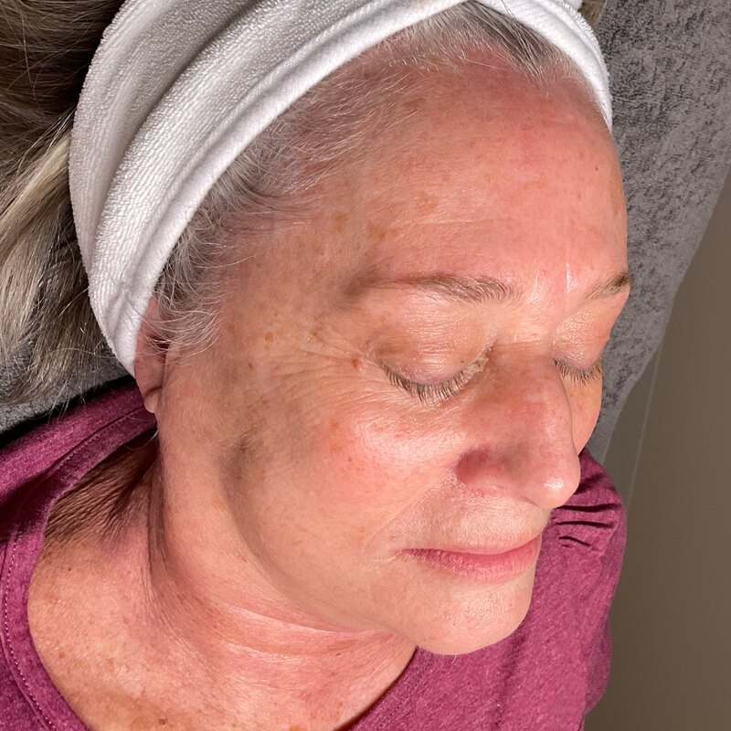MOXI Laser Before & After Image
