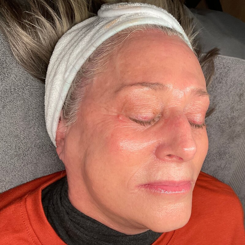 MOXI Laser Before & After Image