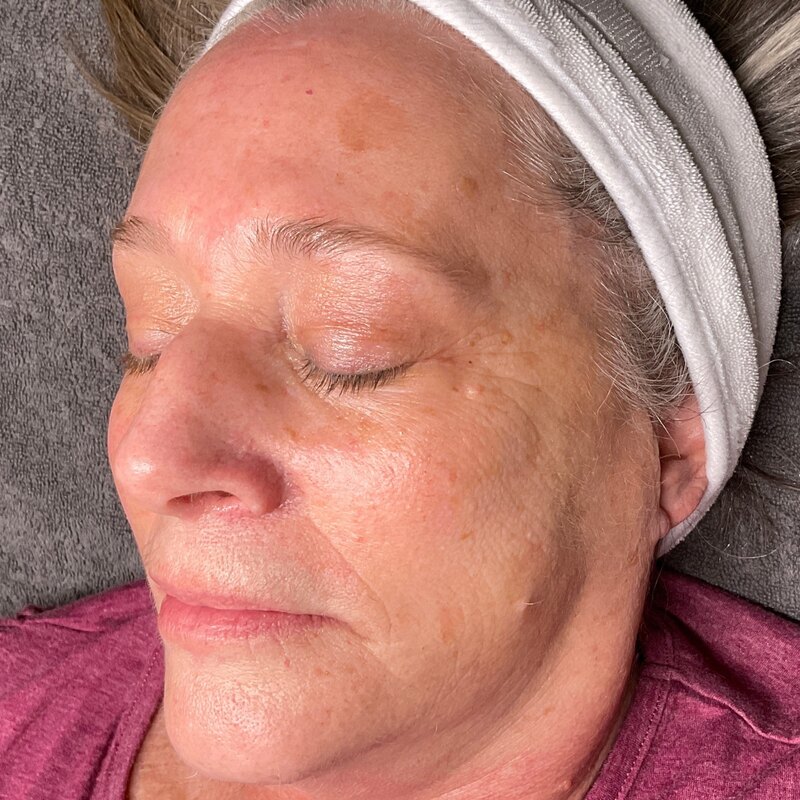 MOXI Laser Before & After Image