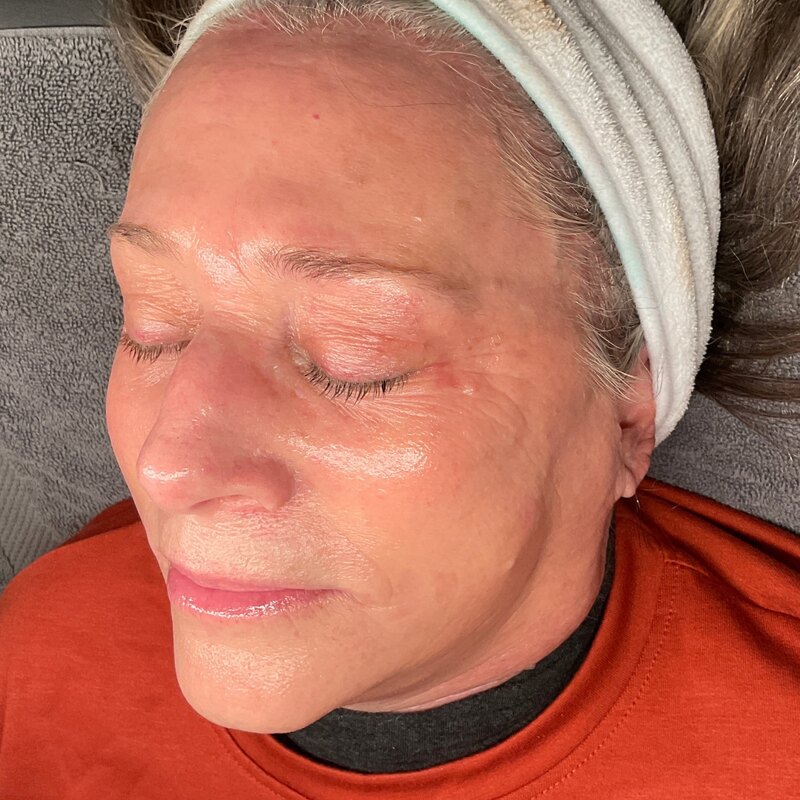 MOXI Laser Before & After Image