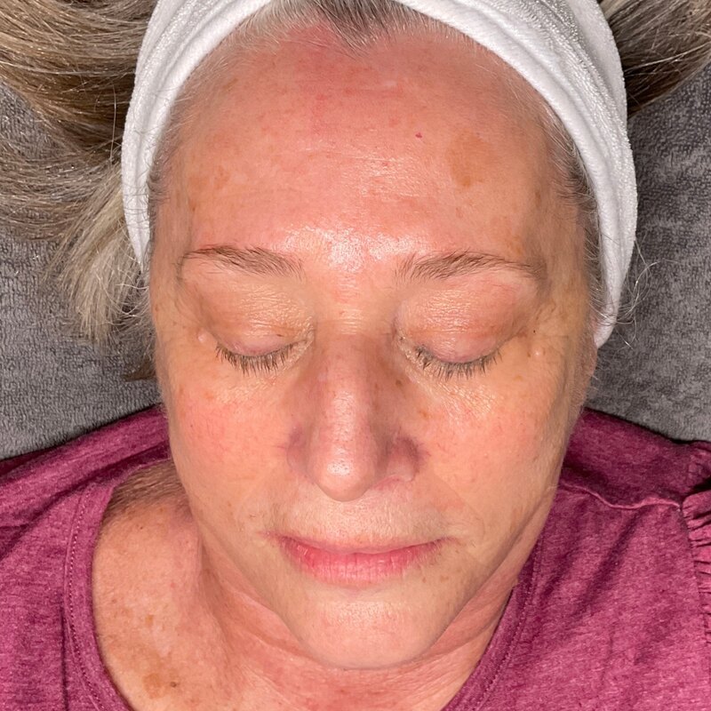 MOXI Laser Before & After Image