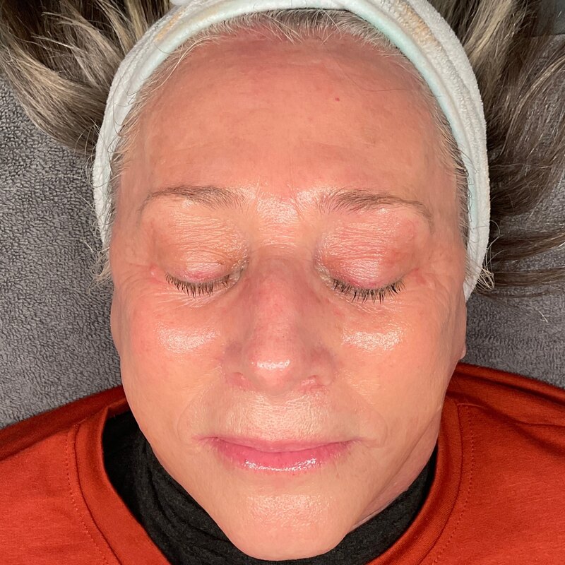 MOXI Laser Before & After Image