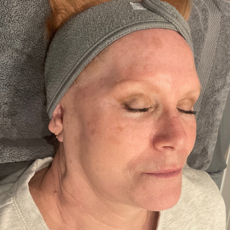 MOXI Laser Before & After Image