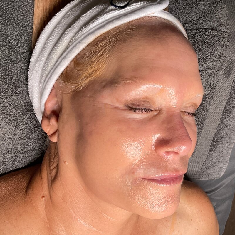 MOXI Laser Before & After Image