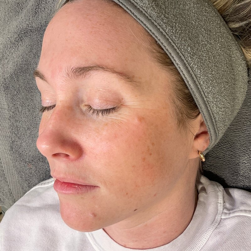 MOXI Laser Before & After Image