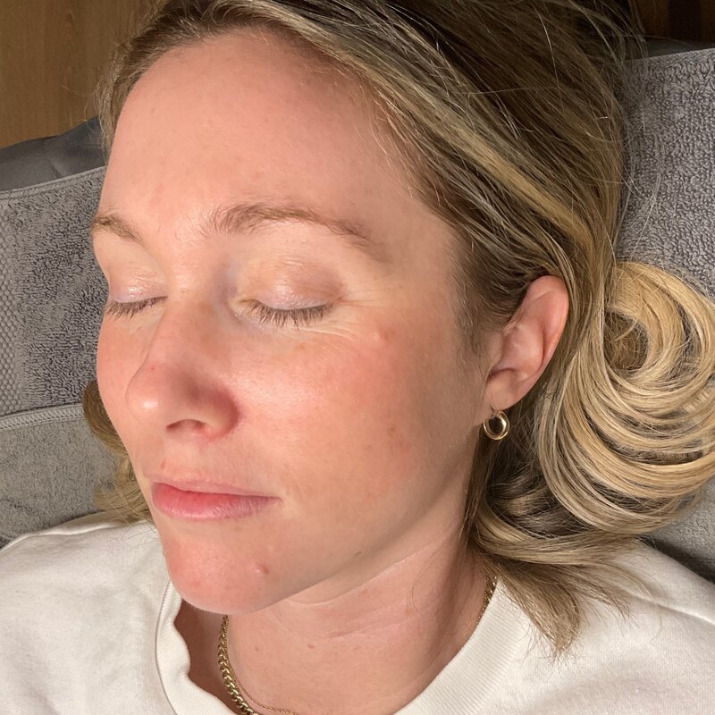MOXI Laser Before & After Image