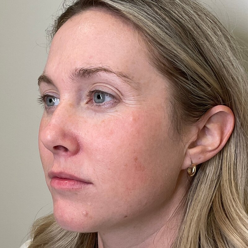 MOXI Laser Before & After Image