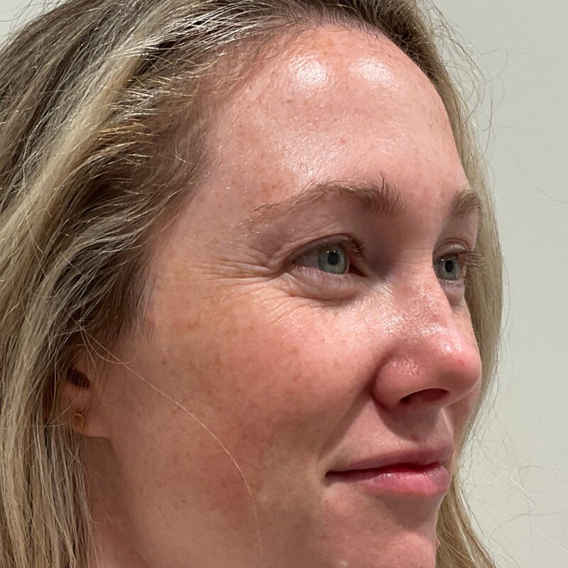 MOXI Laser Before & After Image