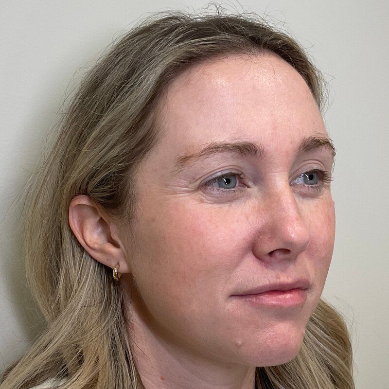 MOXI Laser Before & After Image