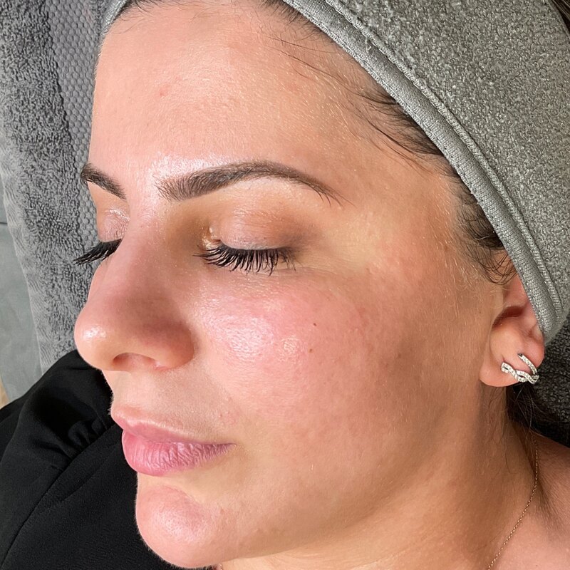MOXI Laser Before & After Image