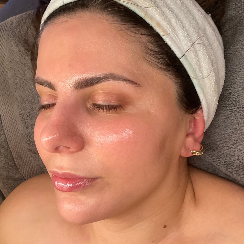MOXI Laser Before & After Image