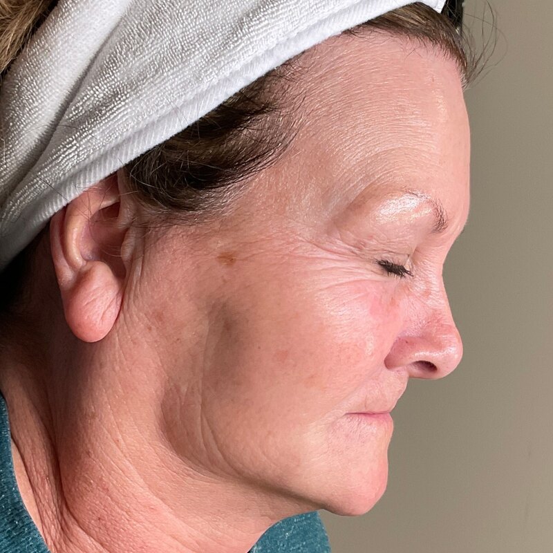 MOXI Laser Before & After Image