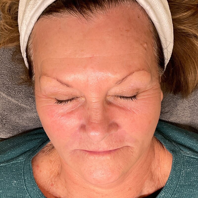 MOXI Laser Before & After Image