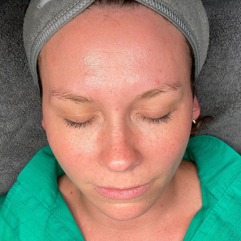 MOXI Laser Before & After Image