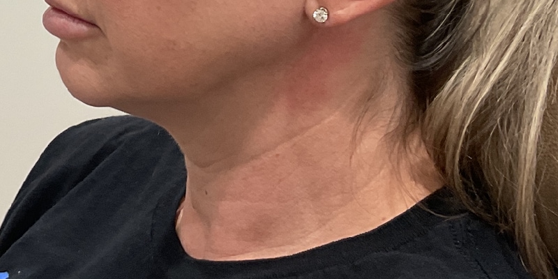 Neck Rejuvenation Before & After Image