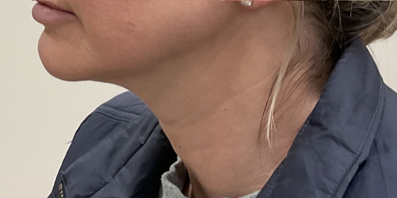 Neck Rejuvenation Before & After Image