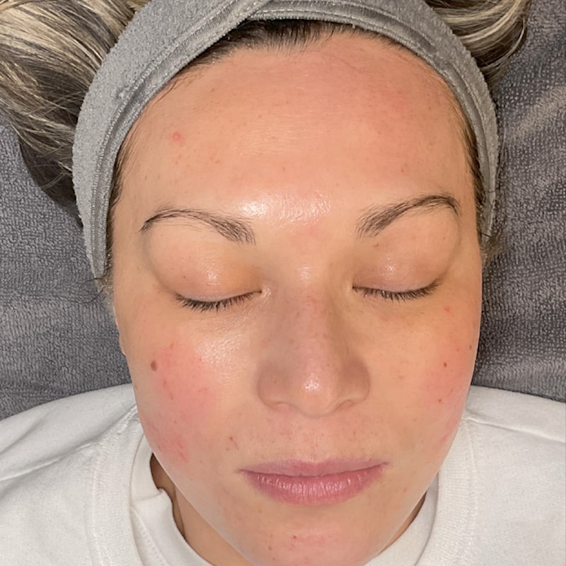 Sciton BBL Before & After Image