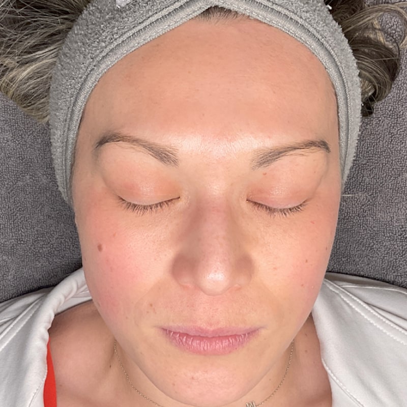 Sciton BBL Before & After Image