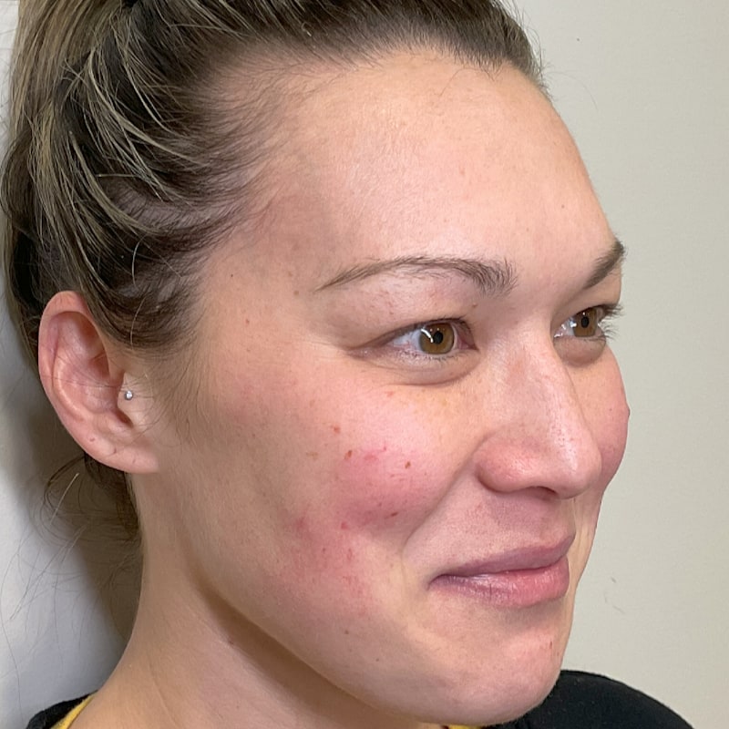 Sciton BBL Before & After Image