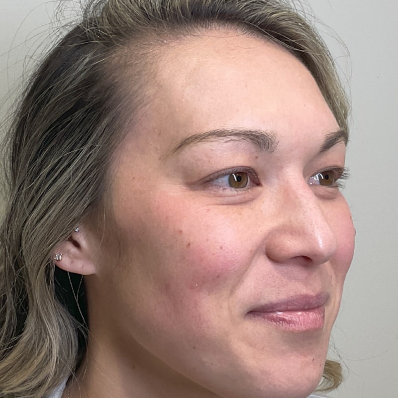 Sciton BBL Before & After Image