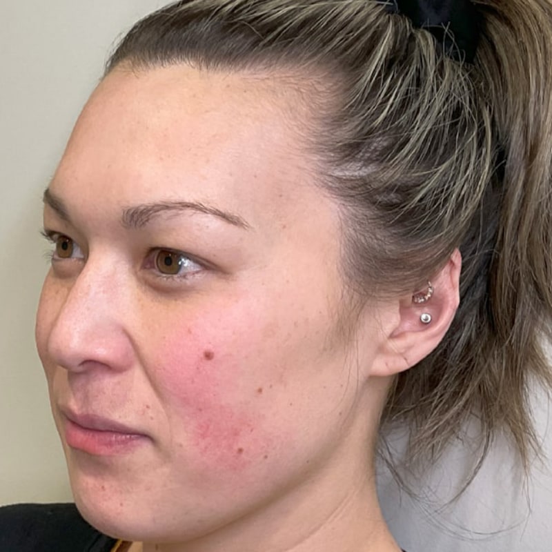 Sciton BBL Before & After Image