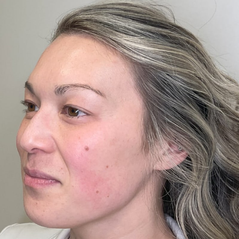 Sciton BBL Before & After Image