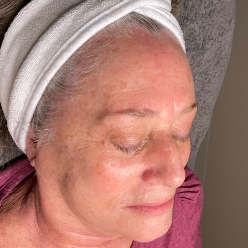 sciton BBL Before & After Image