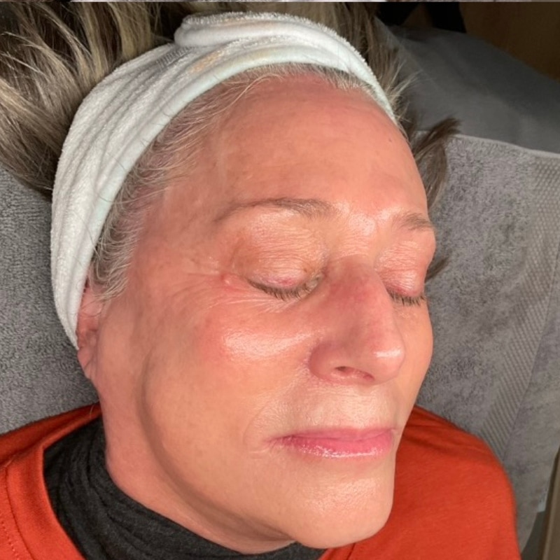 sciton BBL Before & After Image