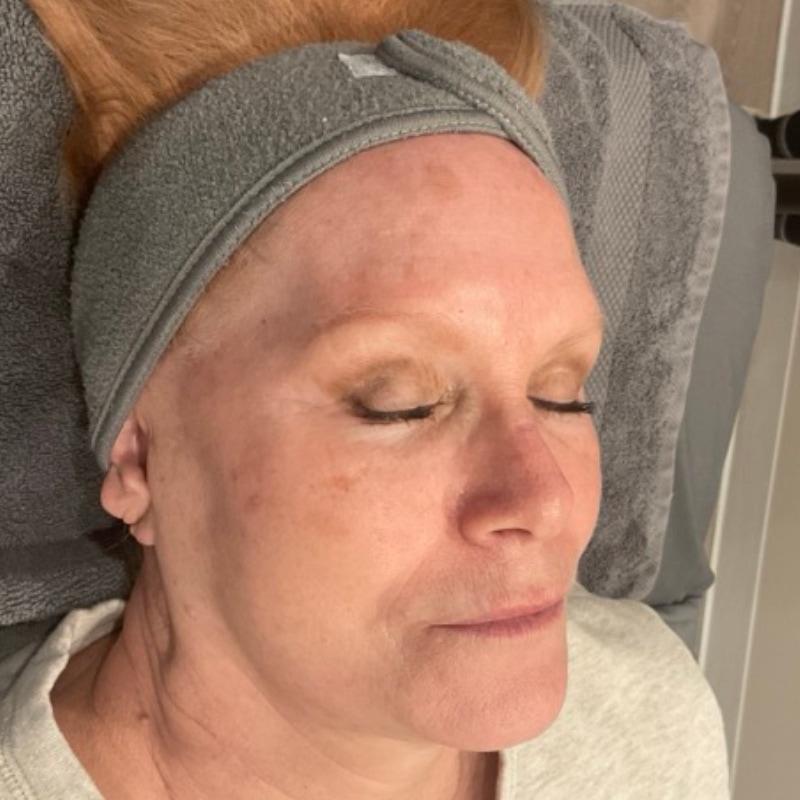 Sciton BBL Before & After Image