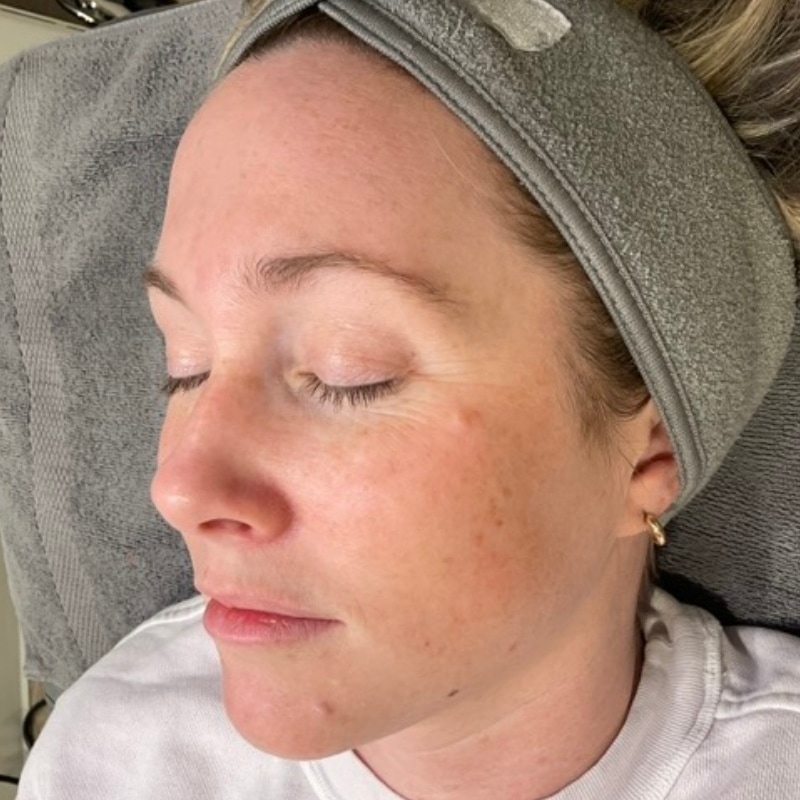 Sciton BBL Before & After Image