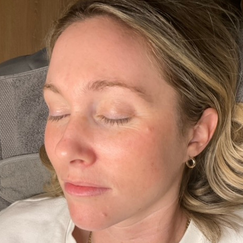 Sciton BBL Before & After Image