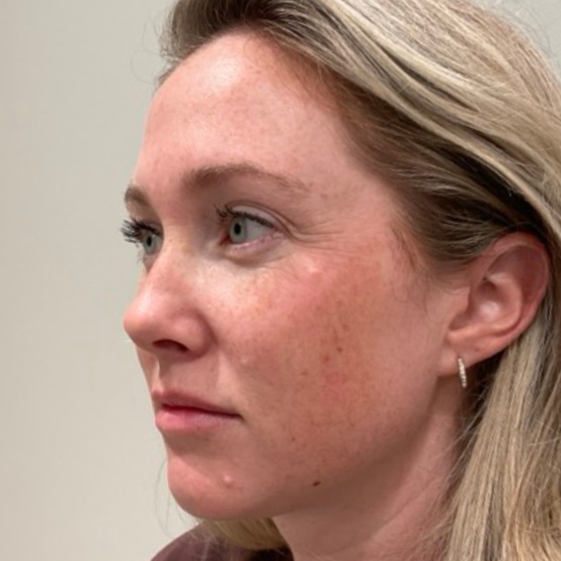 Sciton BBL Before & After Image