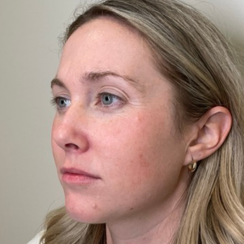 Sciton BBL Before & After Image